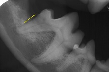 Periodontal Pocket May 2009-03