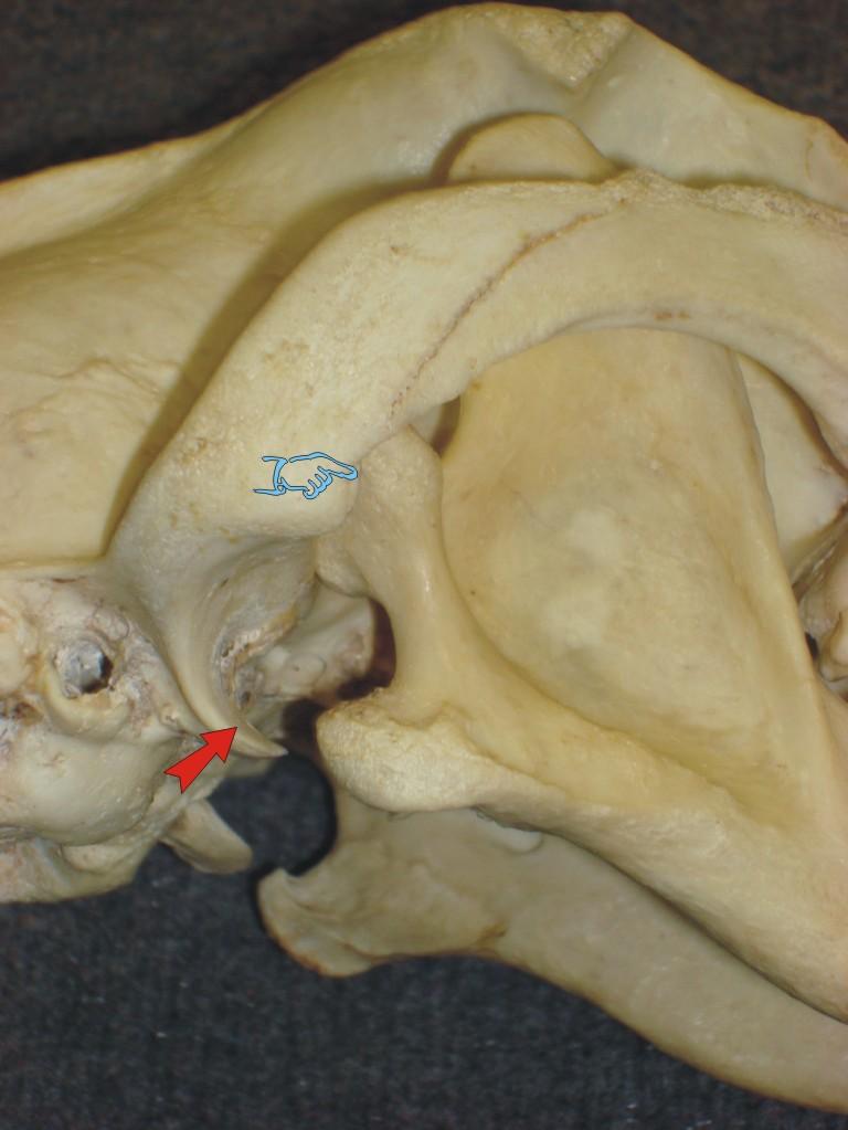 TMJ Reduction -Luxation of the left condyle 01 (1)