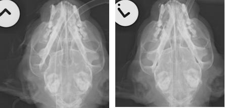TMJ Reduction -Luxation of the left condyle 03